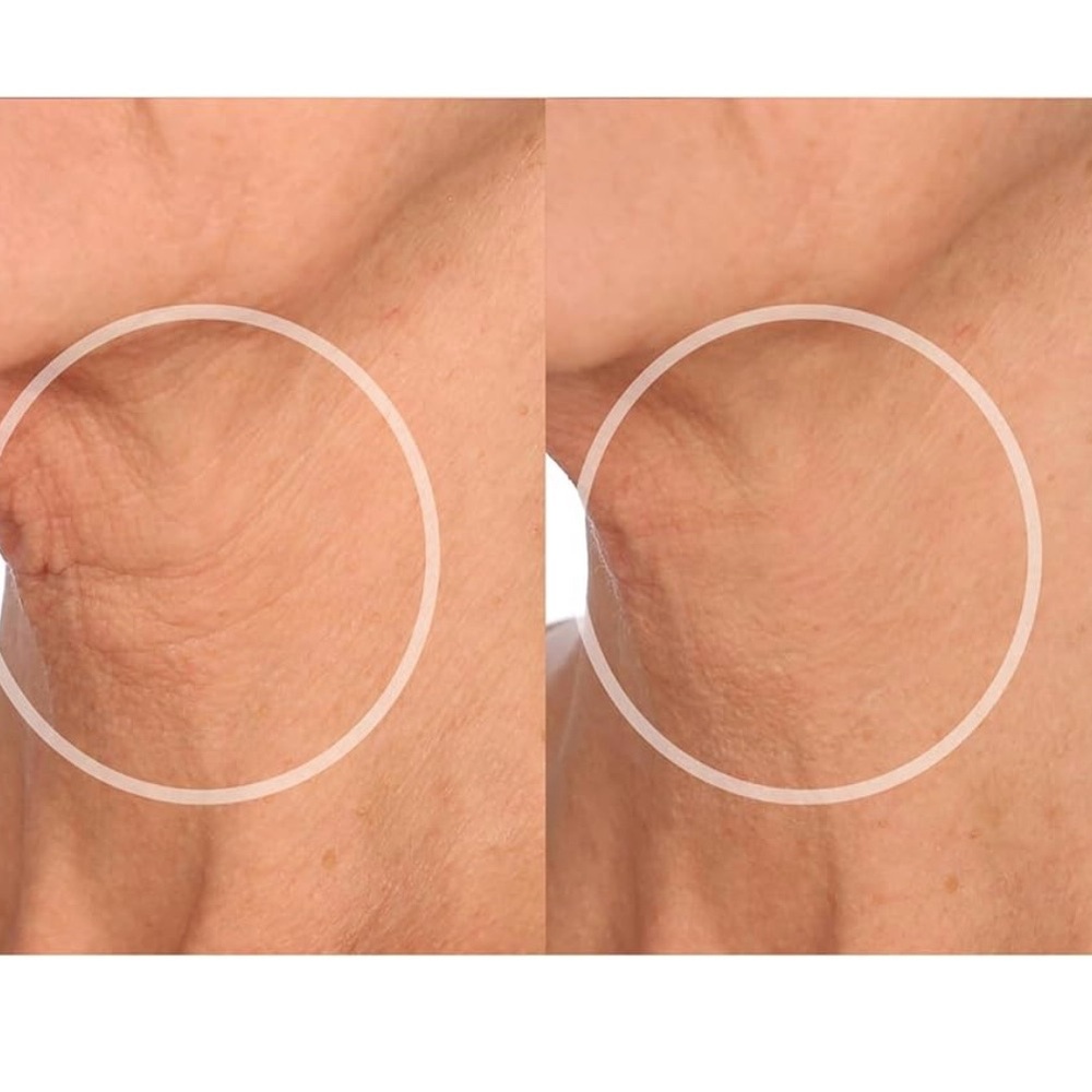 SiO Beauty FaceLift Reusable Anti-Wrinkle Patches for Neck, Forehead, Eye, Smile - Picture 3 of 5